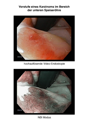 Prof. Dr. Anthony N. Kalloo: Endoluminale Chirurgie (NOTES – Natural Orifice Translumenal Surgery): Wer profitiert von Operationen durch natürliche Körperöffnungen?