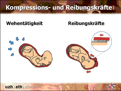 Prof. Dr. Robert Riener, CH-Zürich: Gelgeburt: Reibungskräfte effektiv mindern – Daten aus experimentellen Untersuchungen