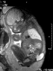 Prophylaxe von Neuralrohrdefekten: Folatversorgung optimieren