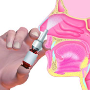 Schmerzlinderung mit Instanyl® nach nur fünf Minuten