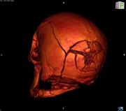 Neue CT-Untersuchung: Virtuelle Autopsie eine Alternative zur Obduktion