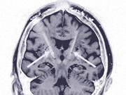 Tiefe Hirnstimulation verbessert die Lebensqualität bei weit mehr Parkinson-Patienten als bisher angenommen