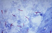 Neues Medikament gegen resistente Tuberkulose-Bakterien
