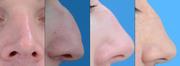 Was bei kosmetischen, ästhetischen und funktionellen Nasen-OPs wichtig ist: Aktuelle Leitlinie für Nasen-Operationen: Kosmetik, Ästhetik, Funktionalität?